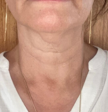 Paralisia de pregas vocais